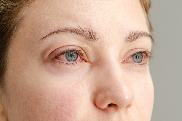Why Does Marijuana Make Your Eyes Red?